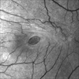 Macular Hole Macular Hole